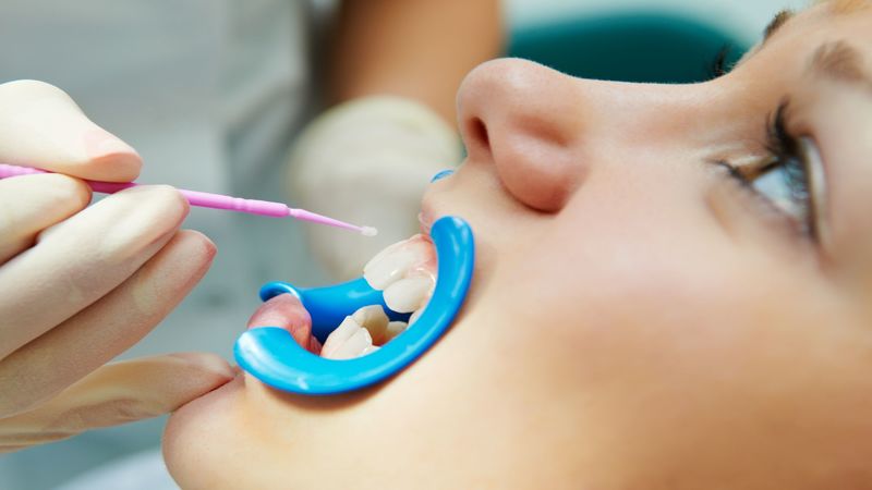 Reasons For Using A Dental Mouth Guard In Tulsa, OK