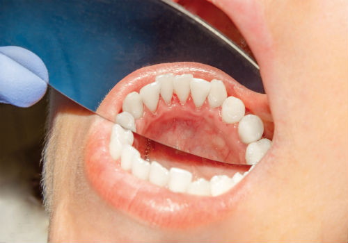 Symptoms and Treatment Options for Gingivitis