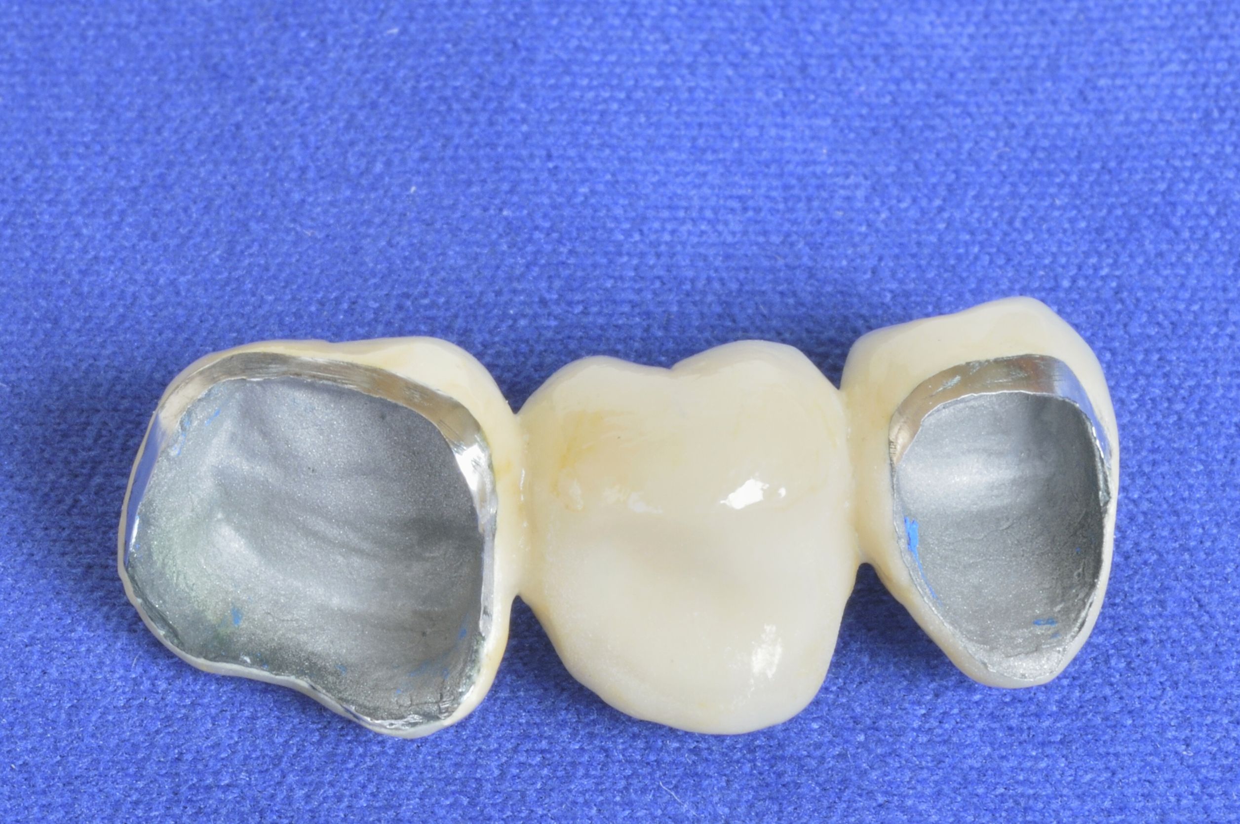 Benefits of Dental Bridges in Hattiesburg, MS