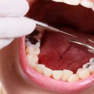 Root Canal Treatment To Repair A Badly Damaged Or Infected Tooth