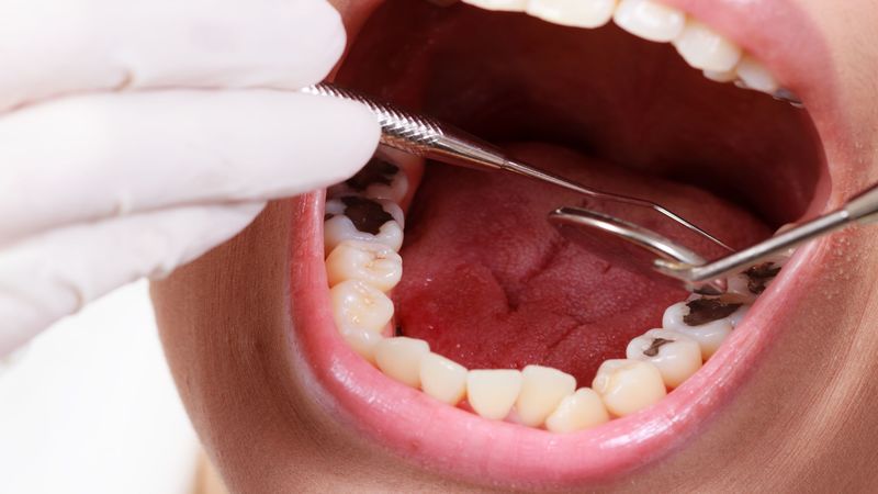 Root Canal Treatment To Repair A Badly Damaged Or Infected Tooth