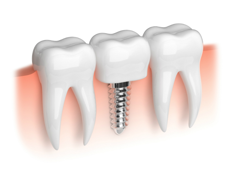 Use Dental Implants Charleston SC to Restore Your Smile