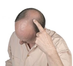 3 Good Reasons to Consider a Hair Transplant in New York City