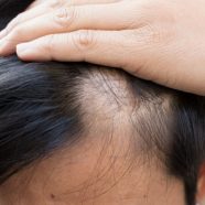 3 Effective, Long-lasting, and Proven Methods for Hair Restoration in CT