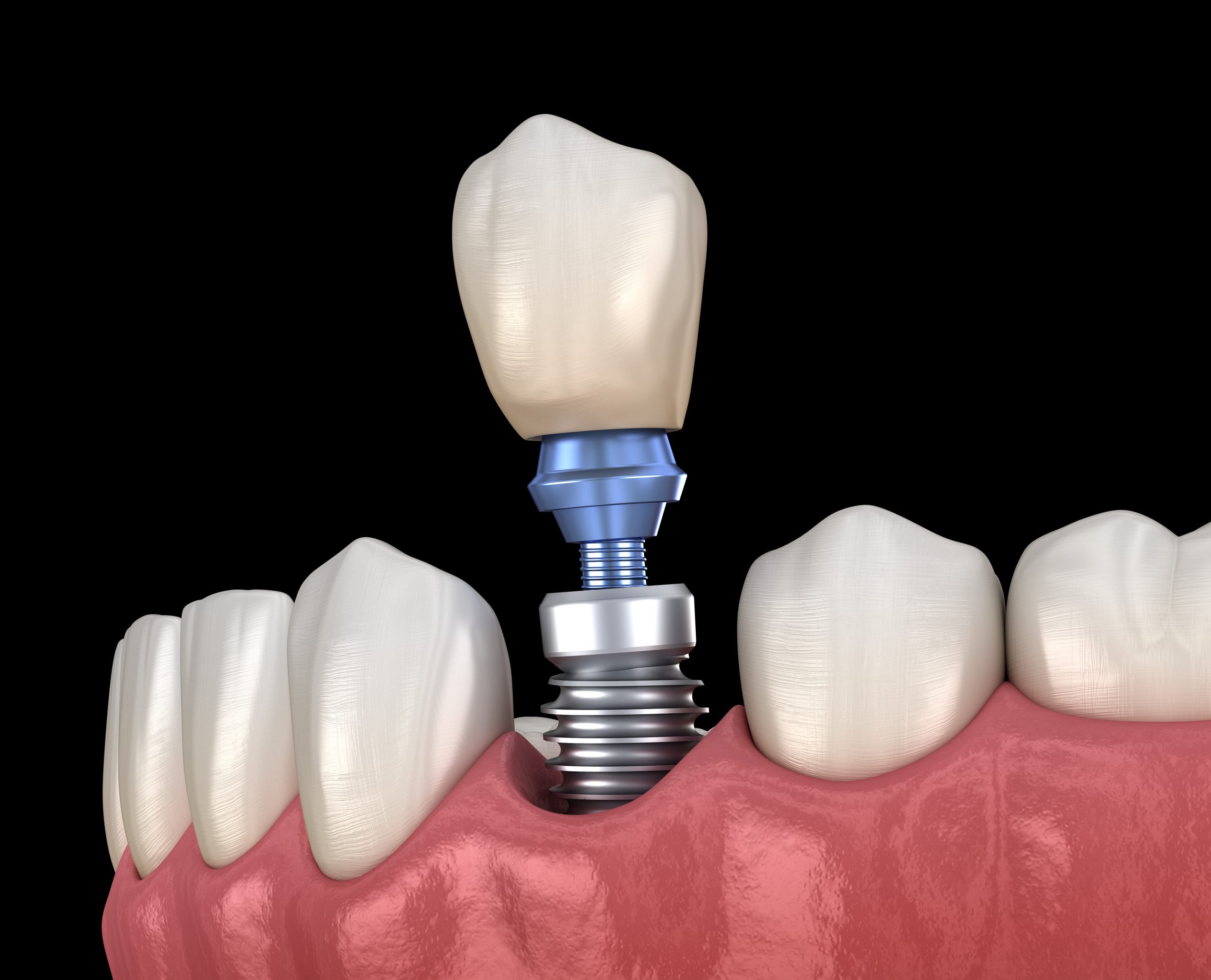 How Denture Repair Clark County, NV Restores Smiles with Lasting Quality and Care