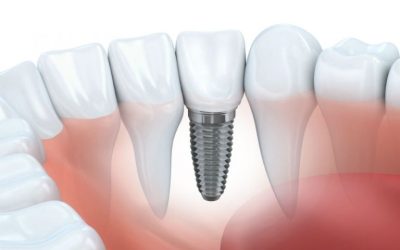 Get Your Confident Smile Back With Dental Implants Daytona Beach Shores FL Solutions