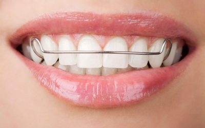 Achieve Your Dream Smile with Teeth Alignment in Onalaska WI for Lasting Confidence