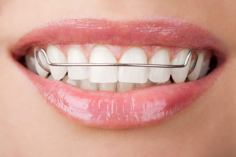 Achieve Your Dream Smile with Teeth Alignment in Onalaska WI for Lasting Confidence