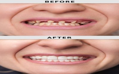 The Benefits of Dental Implants Madison WI Patients Experience After Tooth Loss