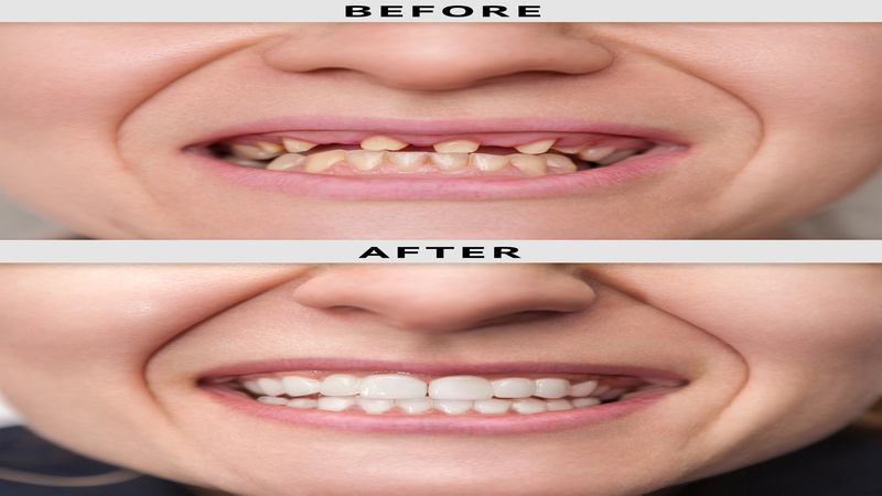 The Benefits of Dental Implants Madison WI Patients Experience After Tooth Loss