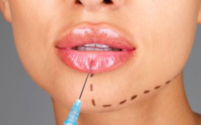 The Safe Approach to Lip Fillers and Enhancement in Bloomington, MN
