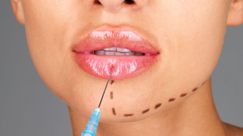 The Safe Approach to Lip Fillers and Enhancement in Bloomington, MN